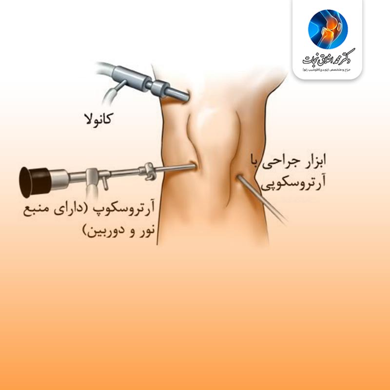 ایا عمل رباط صلیبی سخت است